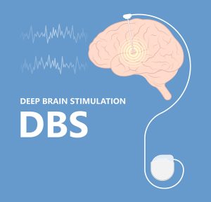 Deep Brain Stimulation (DBS) at Melbourne Neurocare - Melbourne Neurocare